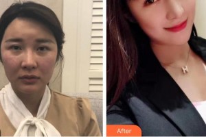 樂(lè)山金手指醫(yī)學(xué)美容診所方名整形價(jià)格表附肋軟骨隆鼻案例展示