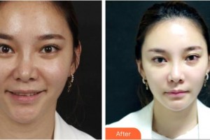 樂(lè)山市人民醫(yī)院燒傷整形外科季明軍整形價(jià)格表附埋線提升案例展示