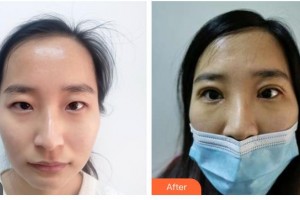 樂(lè)山美銳整形美容診所謝斌冰整形價(jià)格表附眼部綜合案例展示