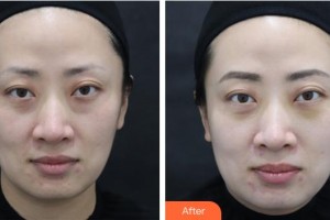 樂(lè)山王玉琨皮膚病?？漆t(yī)院王玉琨整形價(jià)格表附激光去眼袋案例展示