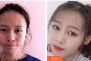 南充陳氏藍(lán)天醫(yī)院醫(yī)學(xué)整形美容中心陳代義整形價(jià)格表附埋線提升案例展示