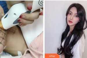 南充中心醫(yī)院整形美容外科高華偉住院醫(yī)師整形價(jià)格表附熱瑪吉案例展示