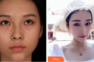 南充五星美容整形門診部劉新一整形價(jià)格表附切開雙眼皮案例展示