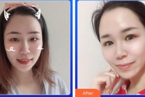 南充友豪醫(yī)院眼科李韋兵整形價(jià)格表附眼部綜合案例展示