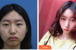 南充潤(rùn)禾皮膚病?？漆t(yī)院萬年整形價(jià)格表附上瞼提肌案例展示