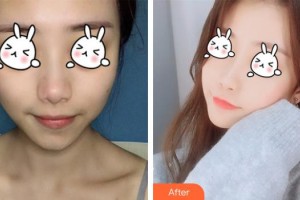 南充潤(rùn)禾皮膚病專科醫(yī)院邱坤整形價(jià)格表附光子嫩膚案例展示