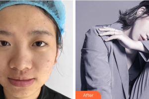 深圳陽光整形美容醫(yī)院樸在久整形價格表附眼部手術案例展示