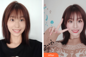 深圳寶城口腔醫(yī)院任斌整形價格表附超聲波洗牙案例展示