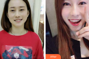 深圳南州口腔門診部李王勝整形價格表附牙齒隱形矯正案例展示