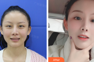 深圳羅湖區(qū)同步口腔門診部胡偉濤整形價(jià)格表附美白瓷貼面案例展示