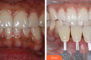 深圳羅湖區(qū)同步口腔門診部黃鐵石整形價(jià)格表附冷光美白案例展示