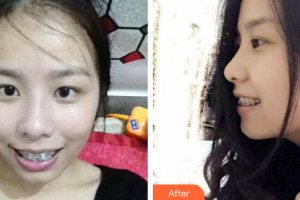 深圳美加美醫(yī)療美容門診部王曉紅整形價(jià)格表附金屬矯正案例展示