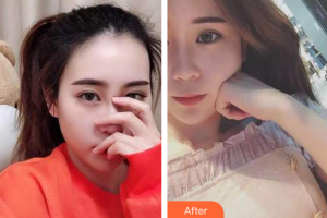 深圳諾德怡景口腔門診部文梁整形價(jià)格表附時(shí)代天使矯正案例展示