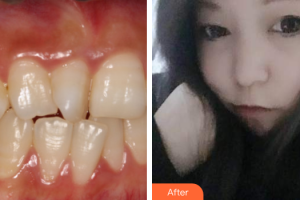 深圳南州口腔門診部鄭輝整形價(jià)格表附隱適美矯正案例展示