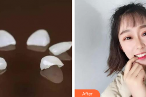 深圳口腔診所顏彬強(qiáng)整形價(jià)格表附瓷貼面案例展示