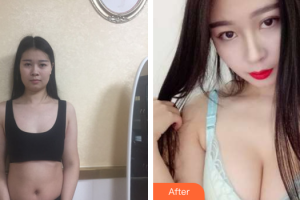 深圳劉博士醫(yī)療美容門診部劉學(xué)軍整形價(jià)格表附自體脂肪隆胸案例展示