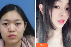 深圳貝加美醫(yī)學(xué)美容門診部夏成龍整形價(jià)格表附假體隆鼻案例展示