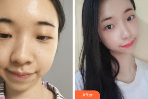 深圳貝加美醫(yī)學(xué)美容門診部易江斌整形價(jià)格表附假體隆鼻案例展示