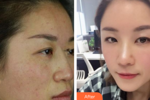 深圳貝加美醫(yī)學(xué)美容門診部鄒媛整形價(jià)格表附自體脂肪填充案例展示