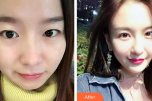 深圳福雅醫(yī)學(xué)美容門診部肖劍光整形價(jià)格表附自體脂肪填充案例展示