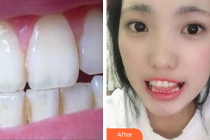 深圳福雅醫(yī)學(xué)美容門診部江穎彤整形價(jià)格表附超聲波潔牙案例展示