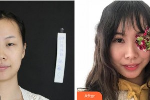 眉山市康復(fù)醫(yī)院眼科李健住院醫(yī)師整形價格表附眼部綜合案例展示