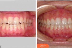 眉山黃記口腔診所陳麒羽整形價格表附隱形托槽矯正案例展示