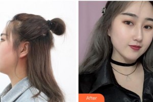 宜賓宜美醫(yī)學(xué)美容診所詹清整形價格表附鼻骨矯正案例展示