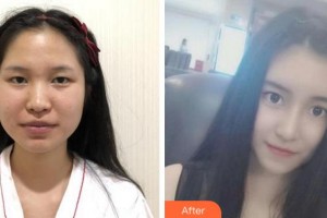 宜賓市第一人民醫(yī)院整形燒傷科陳斌整形價格表附鼻部綜合案例展示