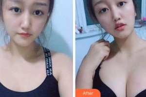 宜賓市第二人民醫(yī)院整形美容科劉建章整形價格表附自體脂肪隆胸案例展示