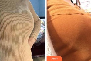 宜賓瑪莉亞醫(yī)院整形美容中心李洪山整形價格表附自體脂肪隆胸案例展示