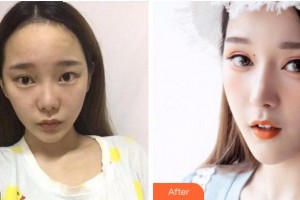 宜賓市第一人民醫(yī)院整形燒傷科鄒同榮整形價格表附假體隆鼻案例展示