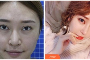 宜賓市第一人民醫(yī)院整形燒傷科毛波整形價格表附鼻部綜合案例展示