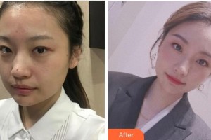 宜賓市第一人民醫(yī)院整形燒傷科呂英整形價格表附激光祛斑案例展示