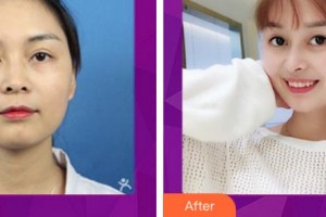 宜賓市第一人民醫(yī)院整形燒傷科陳國雙整形價格表附鼻部綜合案例展示