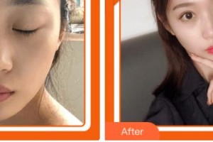 宜賓華仁醫(yī)學(xué)整形美容醫(yī)院汪成整形價格表附鼻部綜合案例展示