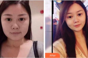 宜賓華仁醫(yī)學(xué)整形美容醫(yī)院鐘華華整形價格表附抗衰案例展示