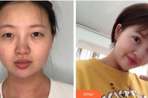 宜賓愛爾優(yōu)視眼科醫(yī)院楊敏整形價格表附眼部綜合案例展示