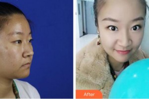 宜賓愛爾優(yōu)視眼科醫(yī)院徐文烽整形價格表附眼部綜合案例展示