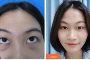 宜賓愛爾優(yōu)視眼科醫(yī)院宋玉偉整形價格表附激光去眼袋案例展示