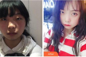 宜賓愛爾優(yōu)視眼科醫(yī)院王朝瑜整形價格表附切開雙眼皮案例展示