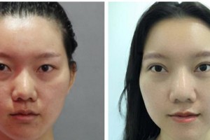 宜賓愛爾優(yōu)視眼科醫(yī)院劉秀麗整形價格表附眼部綜合案例展示