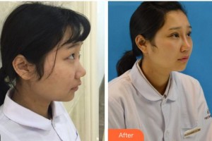 宜賓愛爾優(yōu)視眼科醫(yī)院孫安勝整形價格表附切開雙眼皮案例展示