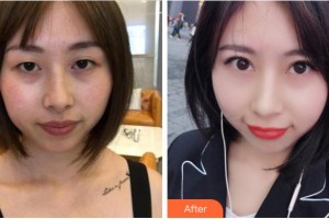 宜賓愛爾優(yōu)視眼科醫(yī)院陳龍華整形價格表附切開雙眼皮案例展示