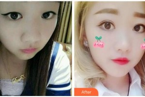 宜賓愛爾優(yōu)視眼科醫(yī)院整形價格表附眼部修復(fù)案例展示