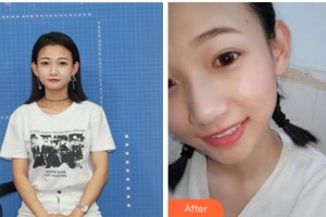 宜賓愛爾優(yōu)視眼科醫(yī)院李娜整形價格表附眼部綜合案例展示