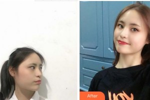 宜賓曼薇醫(yī)學(xué)整形醫(yī)院鄒勇整形價格表附切開雙眼皮案例展示