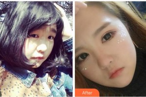 宜賓愛爾優(yōu)視眼科醫(yī)院潘麗梅整形價格表附埋線雙眼皮案例展示