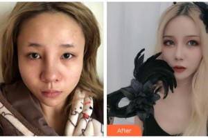 宜賓曼薇醫(yī)學(xué)整形醫(yī)院陳誠整形價格表附眼部綜合案例展示