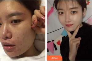 宜賓華膚皮膚病醫(yī)院童顯梅整形價格表附皮膚管理案例展示